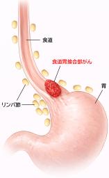 <p>　食道胃接合部がんのイメージ図（大阪大の黒川幸典准教授提供）</p>