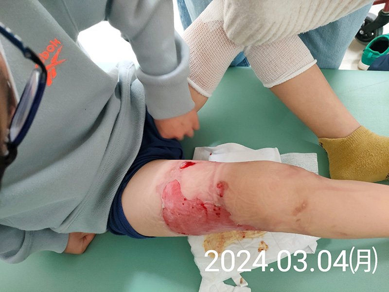 特支学校で男児２人やけど　保護者２人が県を提訴　「なぜ熱湯を授業で」