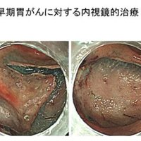 進む胃カメラ治療　死亡数３位に低下　胃がん（２）　千葉県がんセンター内視鏡科医長　北川善康　【９月はがん征圧月間　ちば　がんにうち克つ】（２）