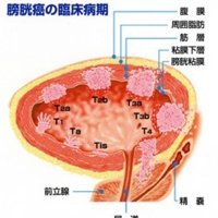 早期見極めが重要に　排尿絡む症状は受診を　膀胱がん総論　千葉県がんセンター泌尿器科主任医長　佐藤陽介　【９月はがん征圧月間　ちば　がんにうち克つ】（９）