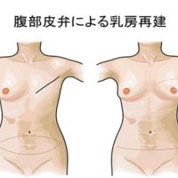 自家組織なら自然に　人工物は他部位傷なく　乳房を再建する手術　千葉県がんセンター形成外科部長　徳元秀樹　【９月はがん征圧月間　ちば　がんにうち克つ】（８）